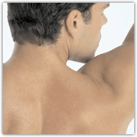 Botox for Excessive Sweating