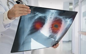 Doctor looking at chest X-Ray