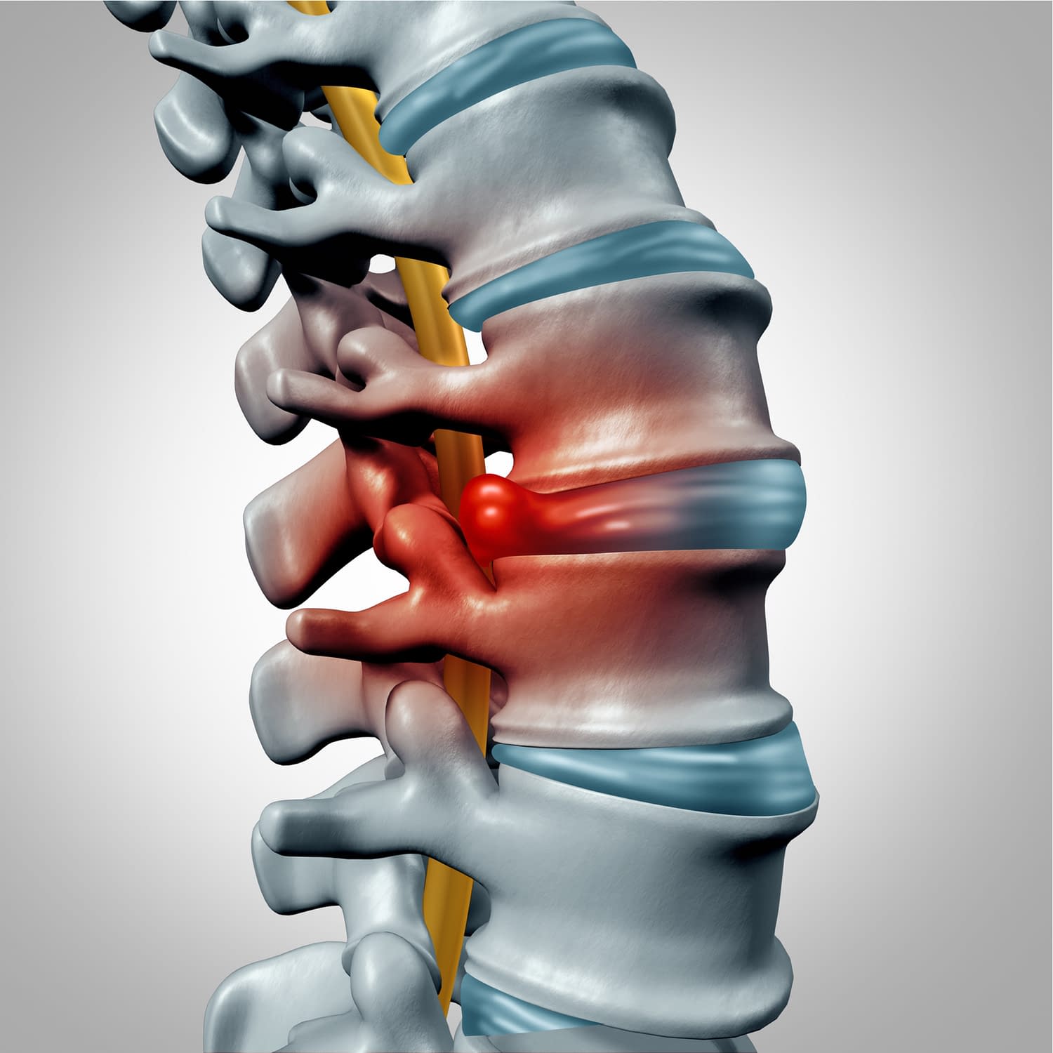 NJ Spine and Wellness offers its New Jersey clients disc injury treatments and rehabilitation for bulging or herniated discs