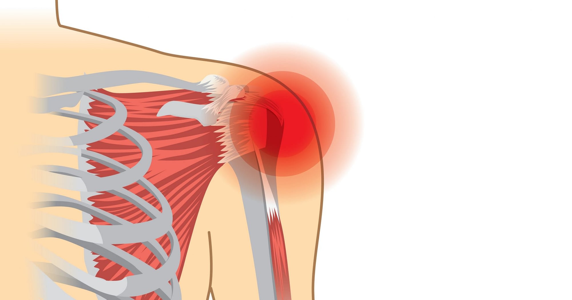 repairing-a-torn-rotator-cuff-new-jersey-high-mountain-orthopedics