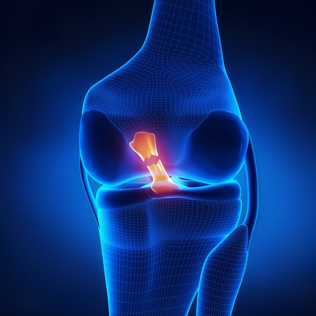 ACL Tear Treatment Exercises – High Mountain Orthopedics