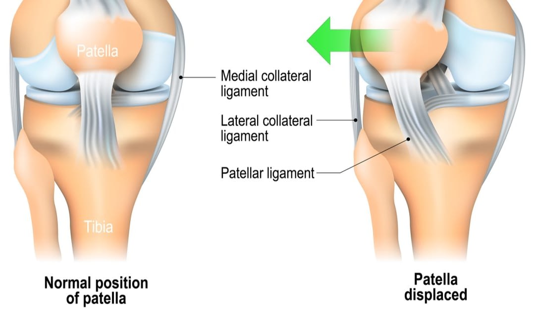 Knee Pain Caused by a Hamstring Injury - Wayne, NJ - High Mountain  Orthopedics