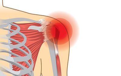 How a Torn Rotator Cuff is Repaired