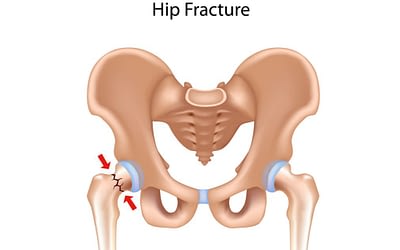 Osteoporosis-Related Hip Fractures: Everything You Need to Know
