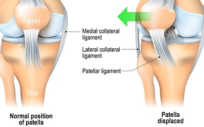 Patellar Dislocations: Signs, Symptoms and Treatments