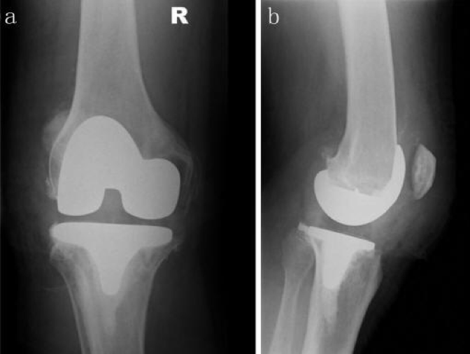 Unicompartmental Knee Replacement - Wayne, NJ - High Mountain Orthopedics