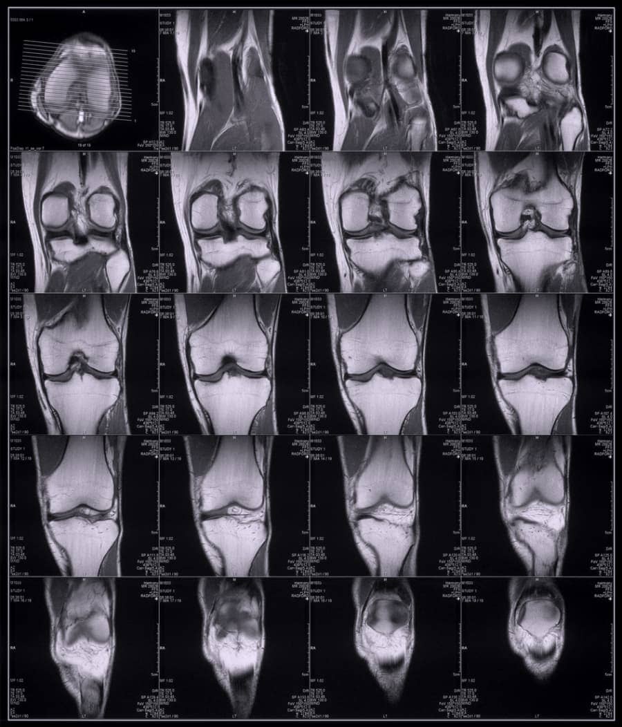 MRI Of Knee