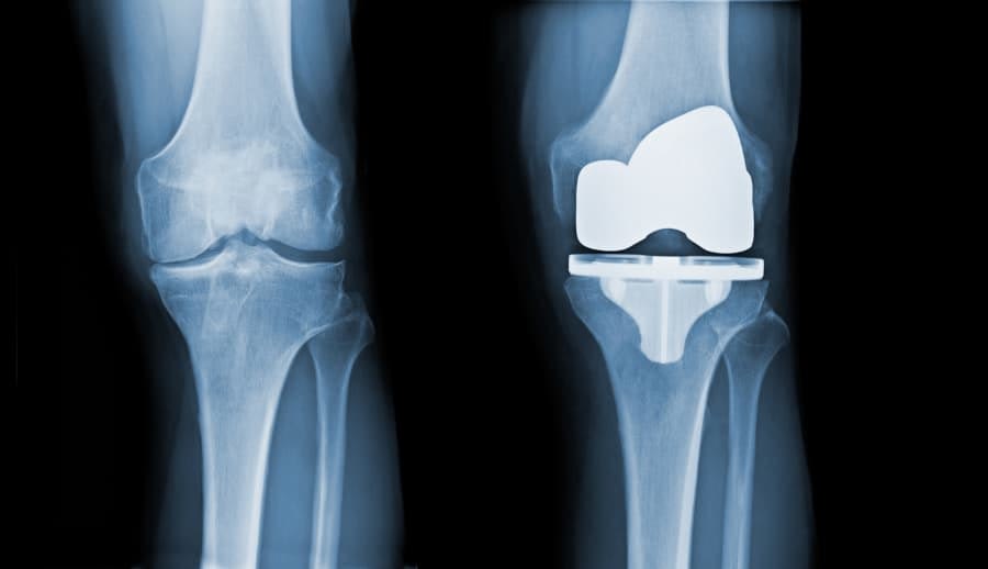 X-Ray Before And After Knee Replacement