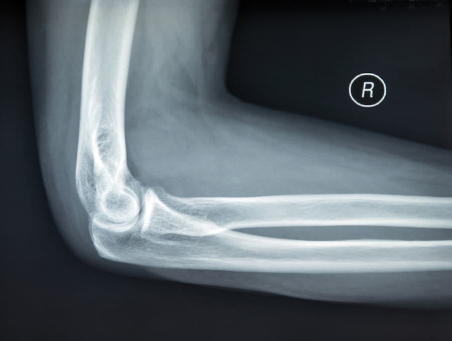 X-Ray Image Of Flexed Elbow