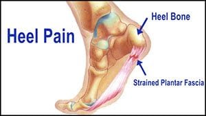 Ultrasound Effective in Treating Heel Pain