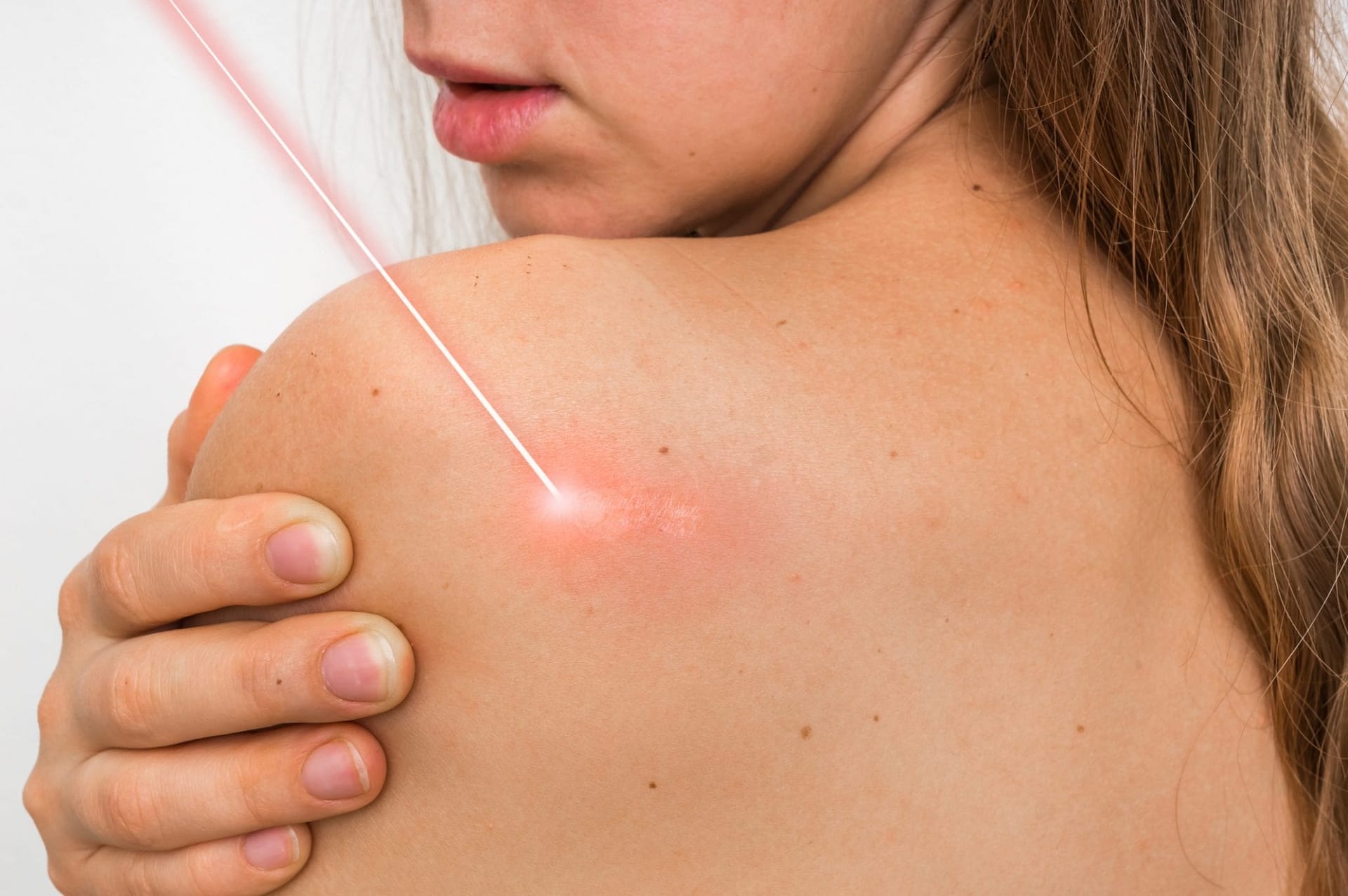 woman with laser on skin