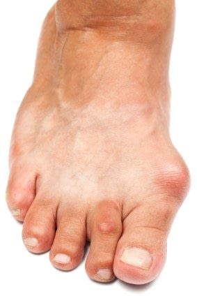 Shoes play a Role in Preventing Bunions