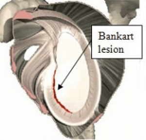 Shoulder Labrum Tears - Englewood, NJ - High Mountain Orthopedics