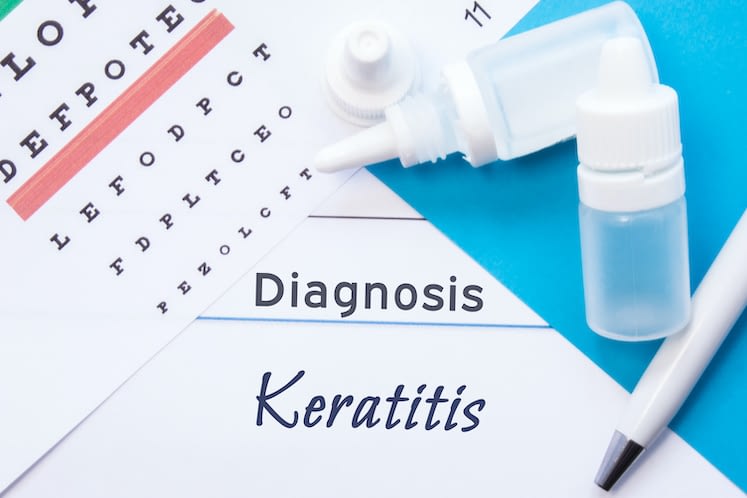 Adjuvant cross-linking doesn’t appear beneficial for bacterial keratitis
