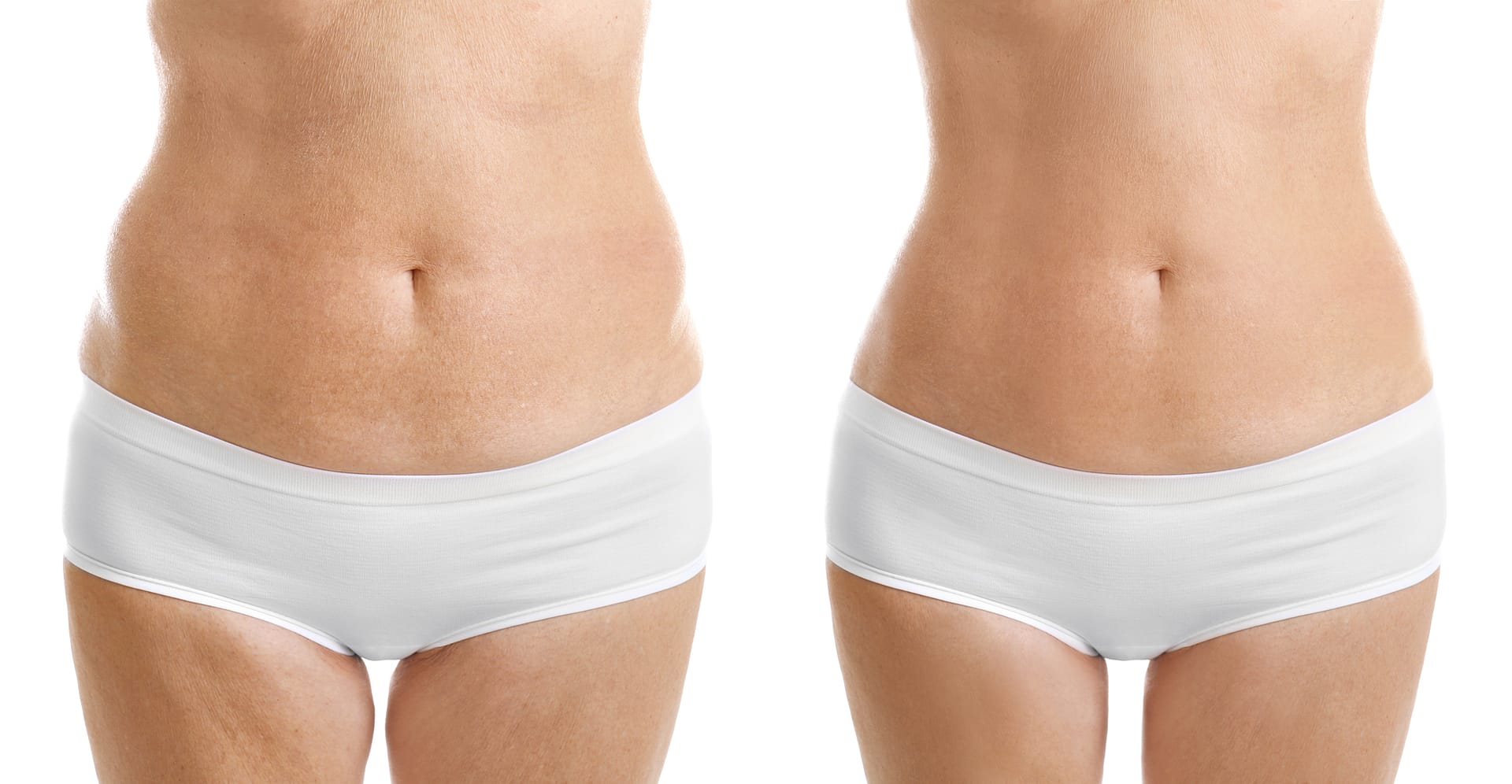 Tummy Tuck vs. Liposuction: What's the difference?