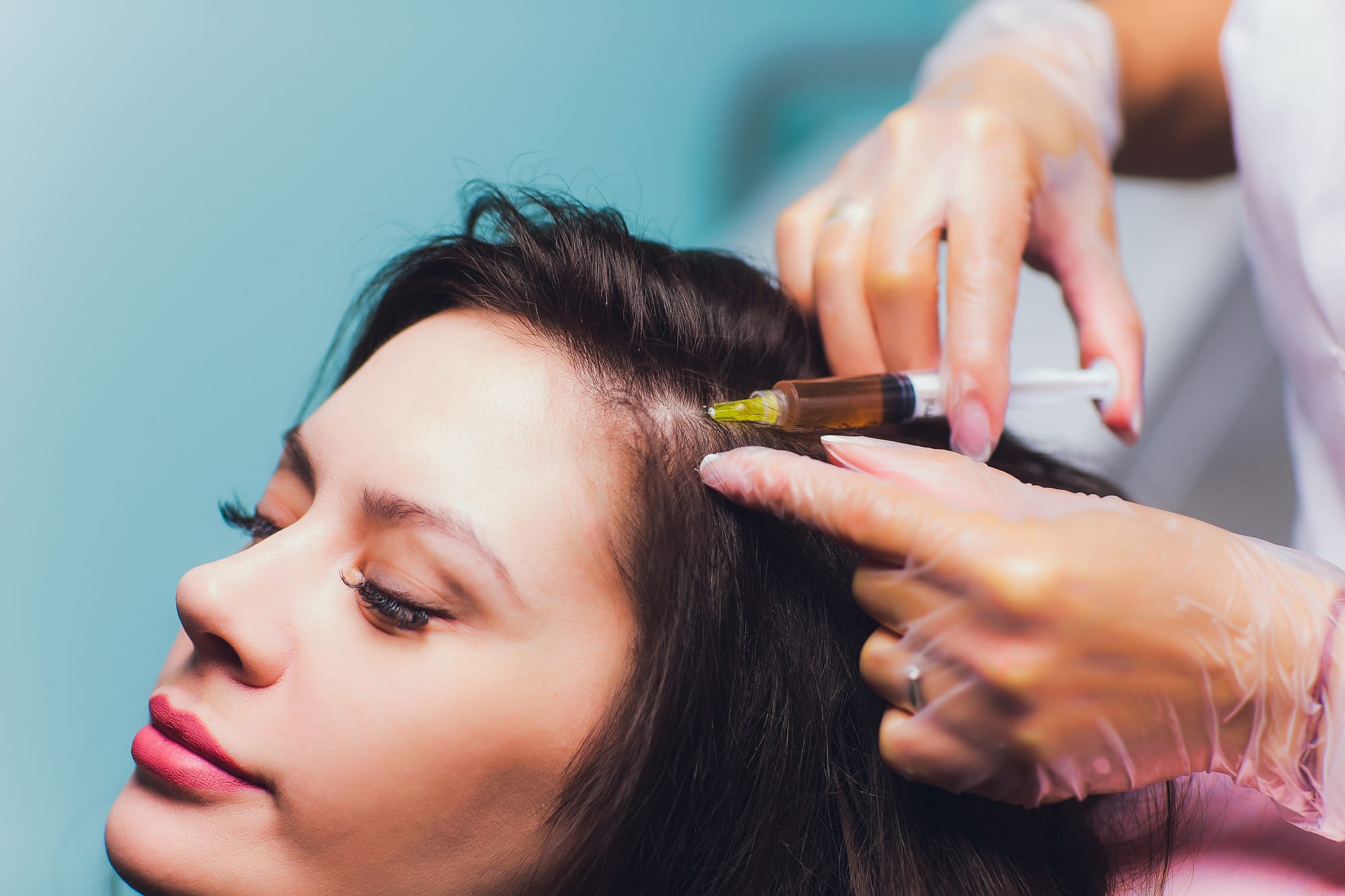 PRP for Hair Loss: What is Platelet Rich Plasma Treatment?