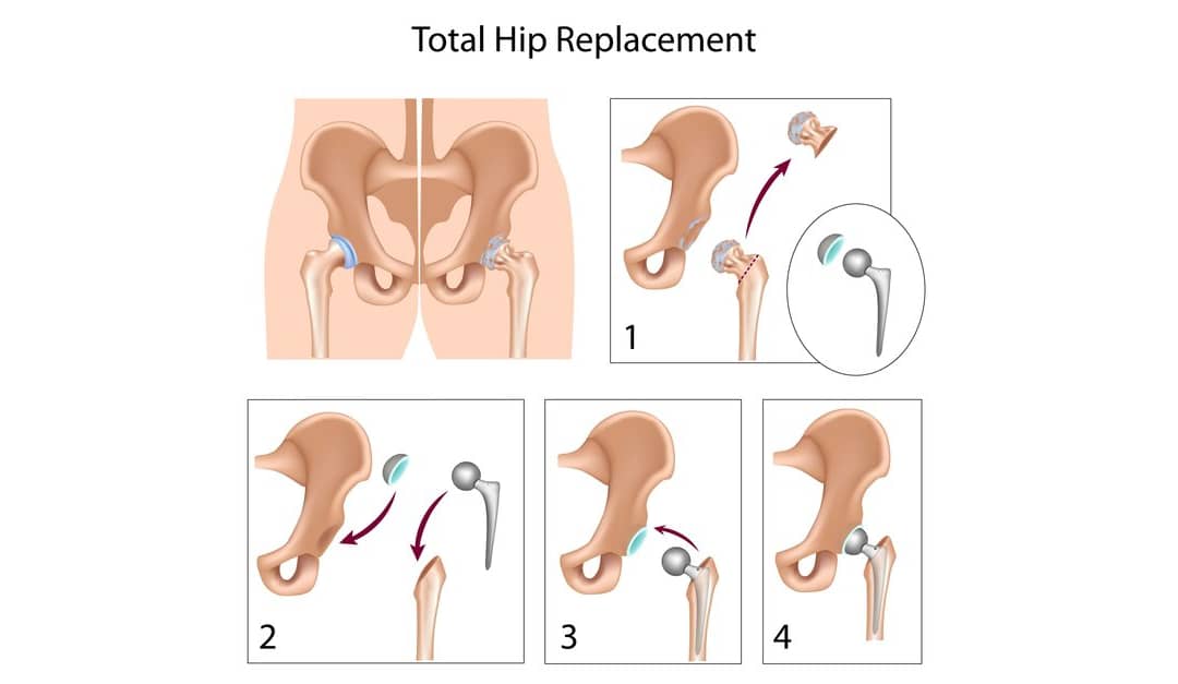 Hip Replacement: Everything You Want to Know