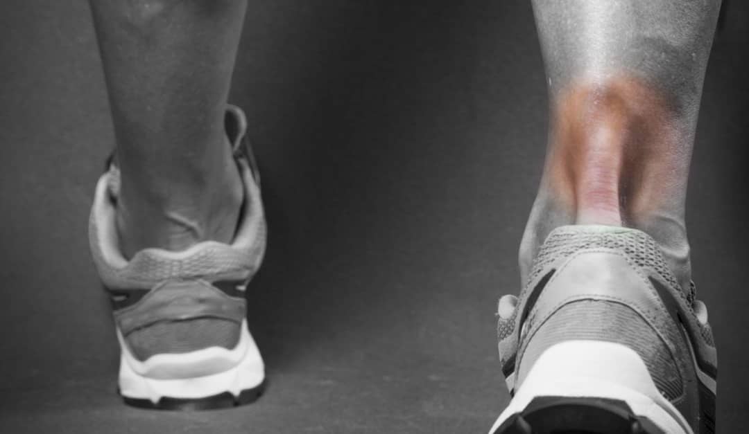 The Signs of Achilles Tendonitis and How To Treat It