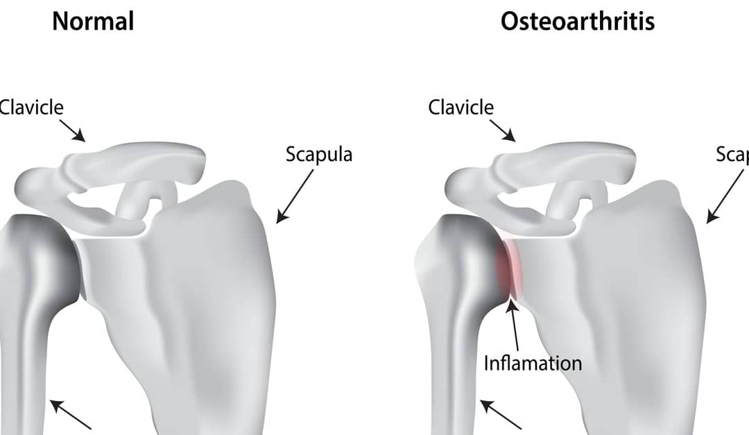 Using Corticosteroids to Treat the Symptoms of Shoulder Arthritis