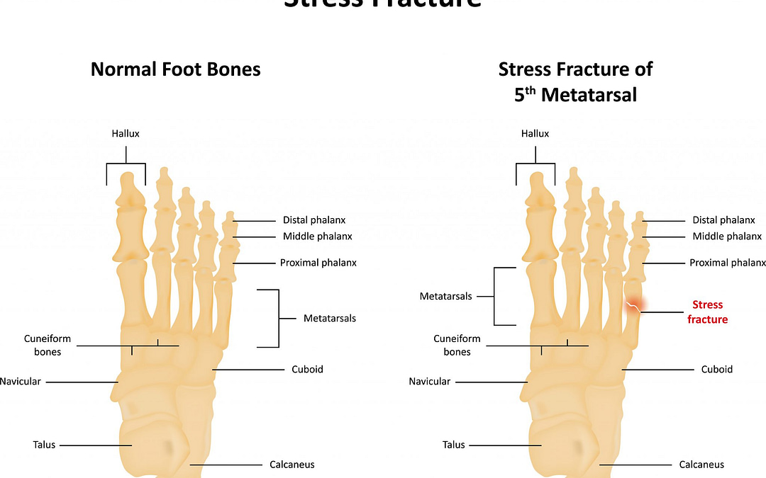 Why Are Stress Fractures So Common In Athletes?