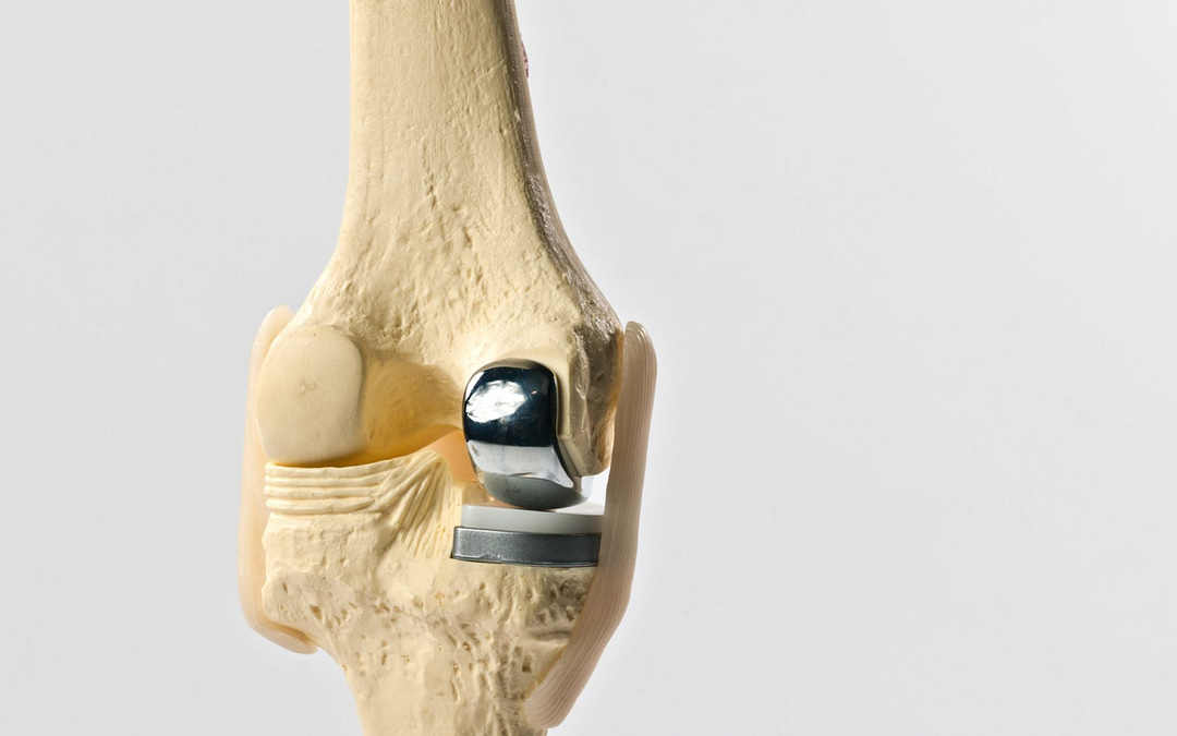 What is Unicompartmental Knee Replacement?