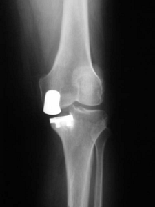 unicompartmental knee replacement