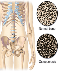 Comparison of Normal Bone With Osteoporosis