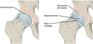 Comparison of Normal Hip with Arthritic Hip