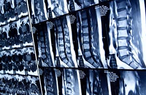 MRI Scans Of A Patient’s Spine