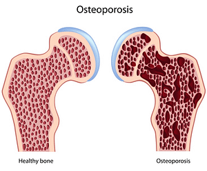 Illustration of Healthy Bone and Osteoporotic Bone