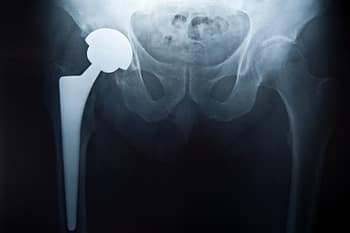 X-Ray Image Of Hip Replacement Prosthetic