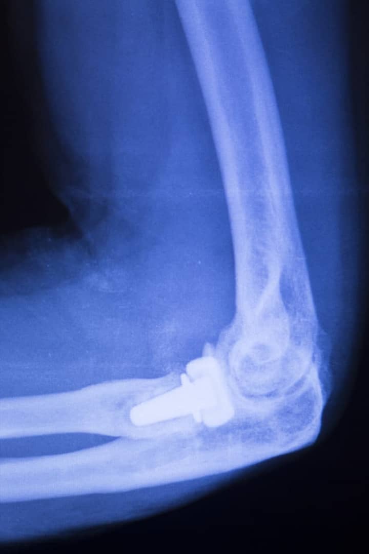 X-Ray Image Of Elbow With Replacement Pin