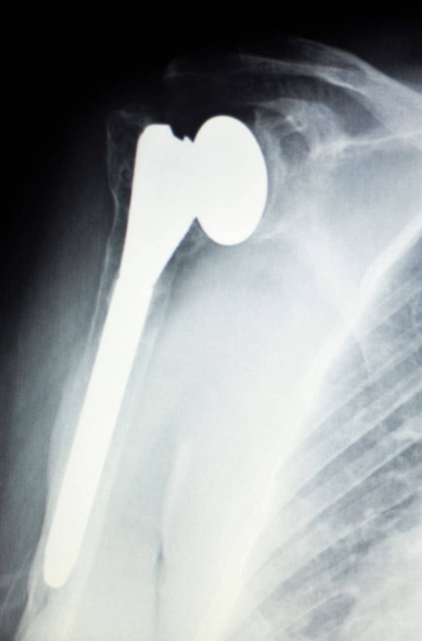 Shoulder Replacement X-Ray