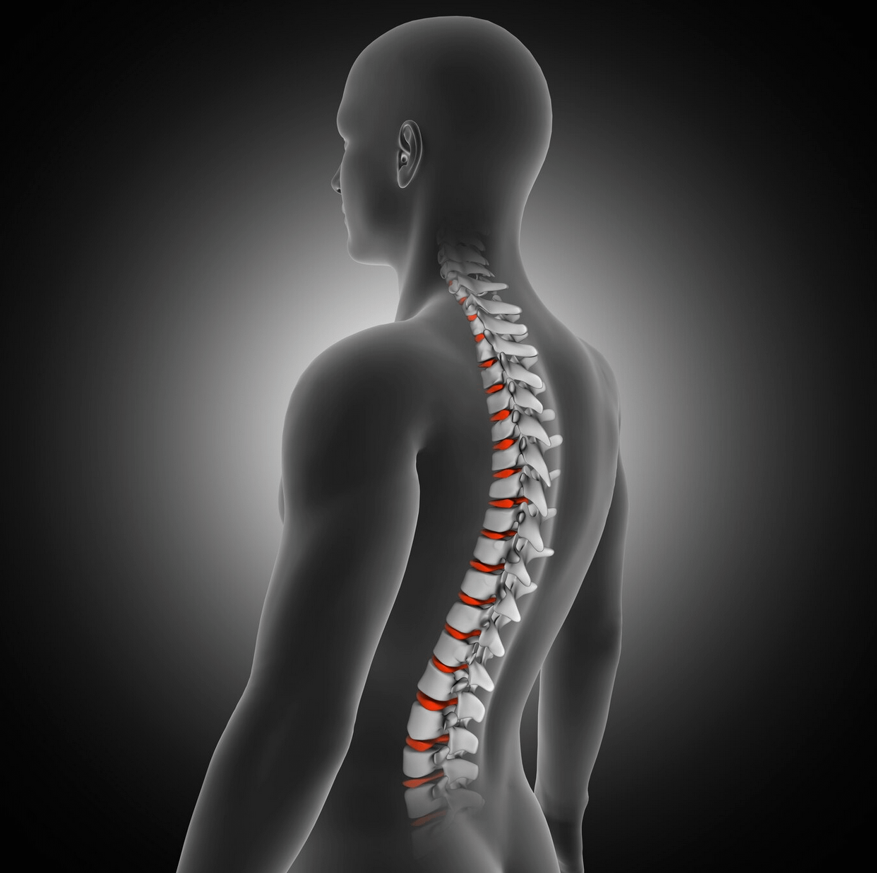 Lumbar Spinal Fusion