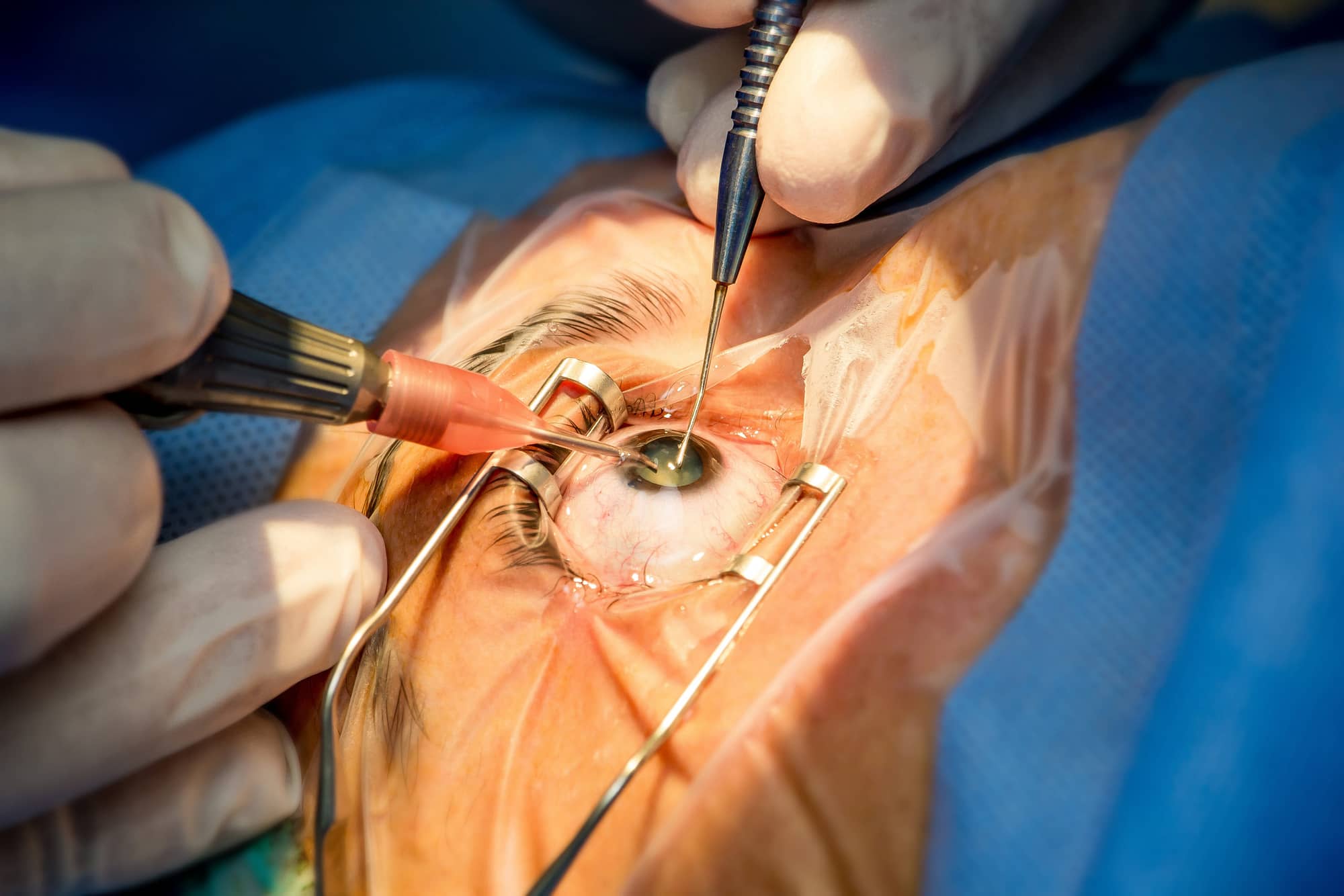 cataract eye surgery