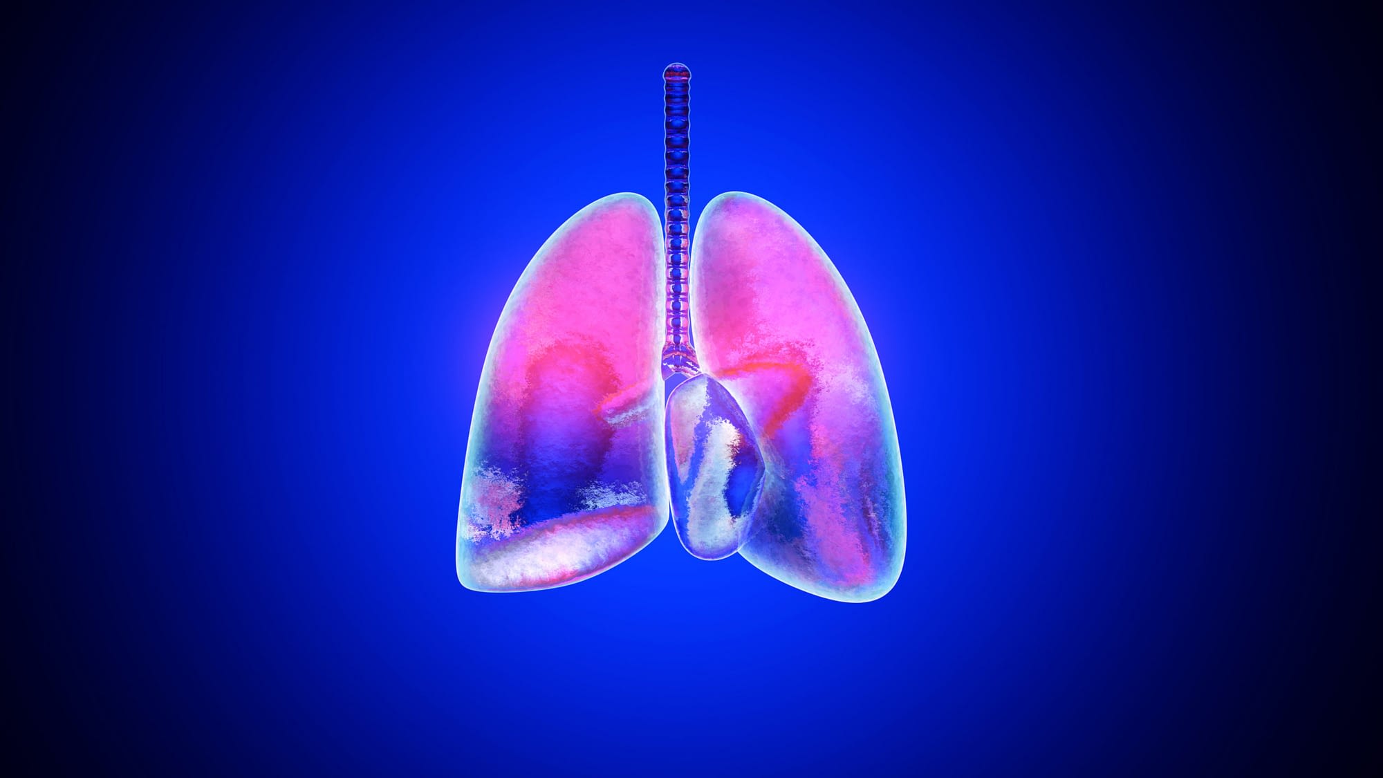 3D illustration of inflamed and infected Lungs