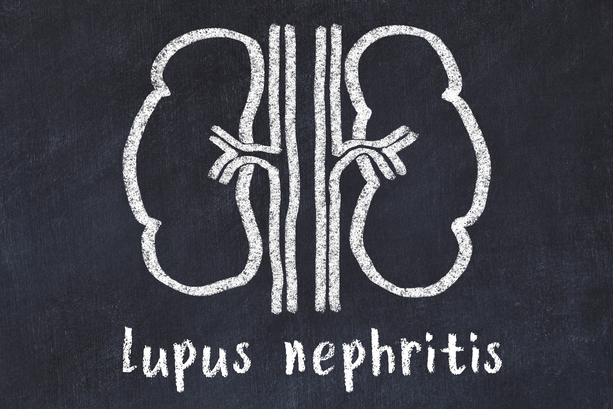 Chalk drawing of human kidneys and medical term lupus nephritis.