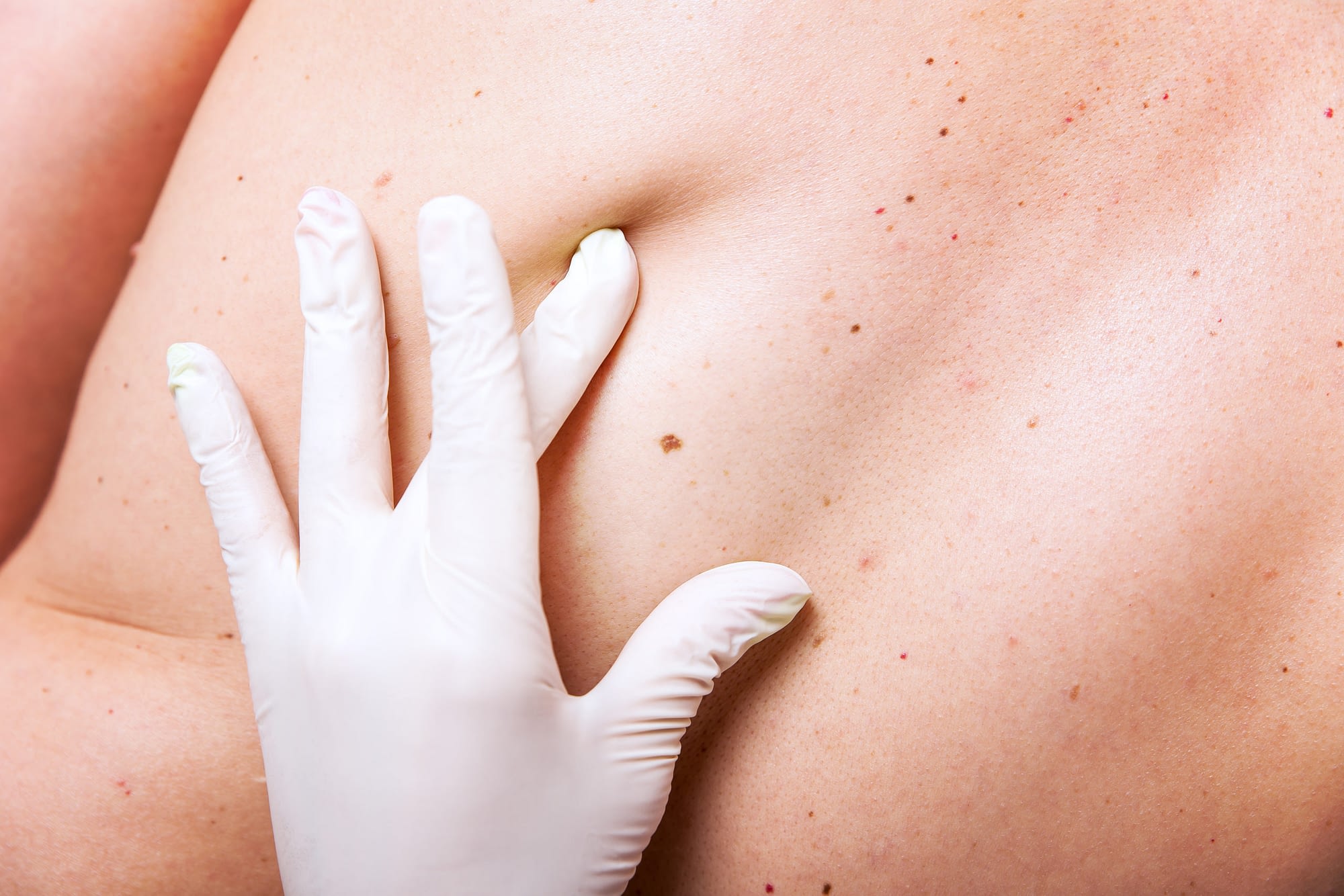 Vorsorge Untersuchung von Hautarzt