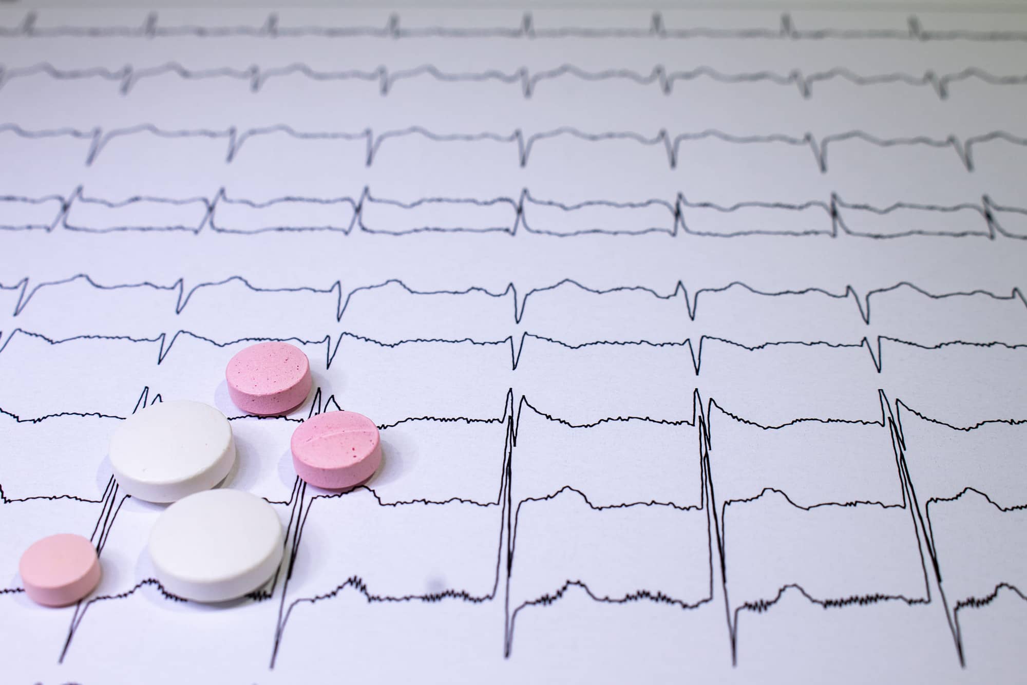 Electrocardiogram with Brugada syndrome. Colored pills on an EKG