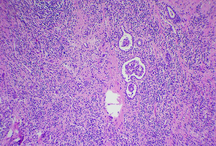 Case Report: Goodpasture Syndrome and Hemorrhage After Renal Biopsy
