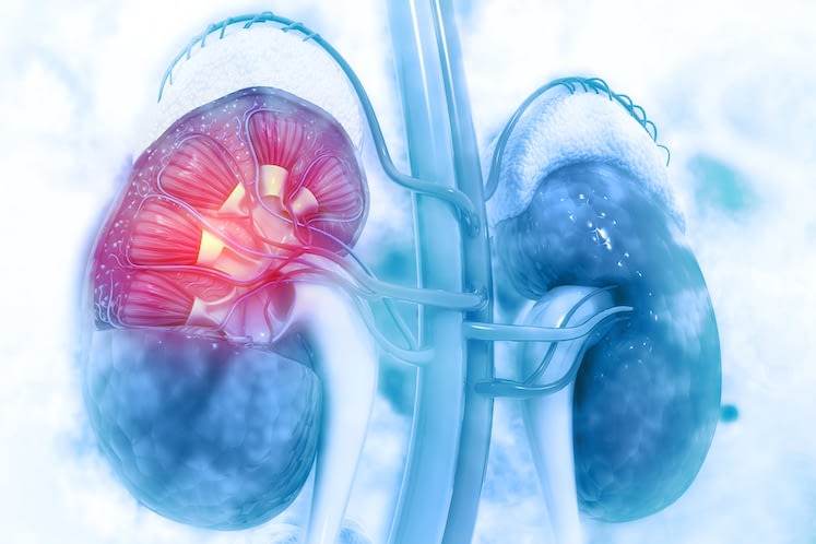 A Deeper Look at Rare and Complex Kidney Diseases