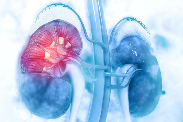 A Deeper Look at Rare and Complex Kidney Diseases