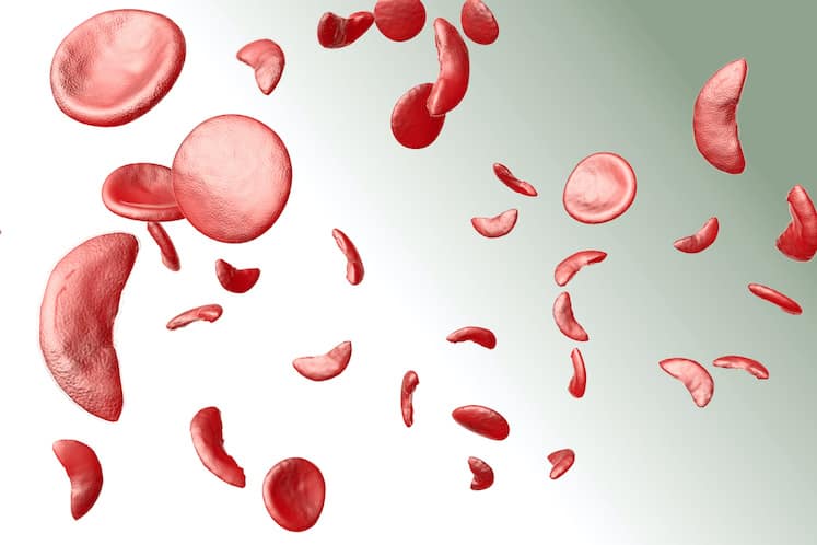 ASH: Novel Fetal Hemoglobin Repressor for Sickle Cell Disease Identified