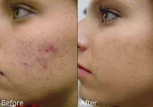 Vivace™ Micro-Needling with PRP - Top Cosmetic and Reconstructive Surgeon in New York and New Jersey