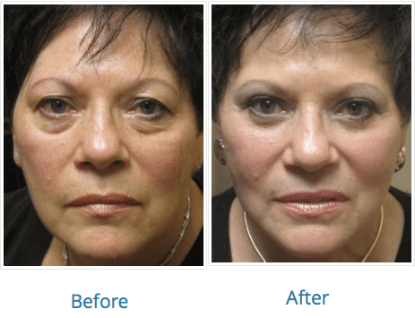 Picture Of A New York Cosmetic And Reconstructive Surgeon's Results - Jeffrey Schiller, MD