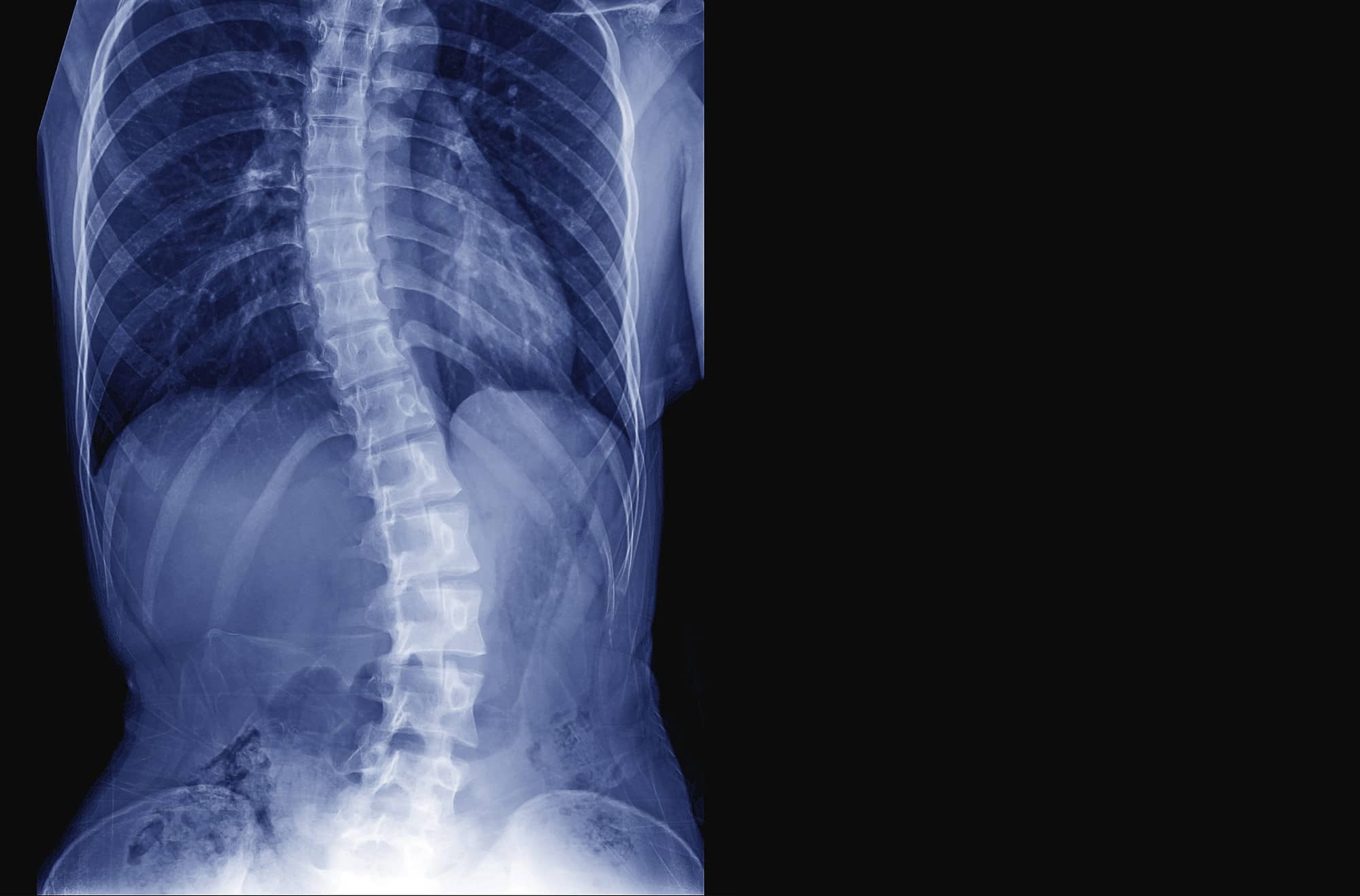 X-ray image of teenager patient spine show Scoliosis and spinal