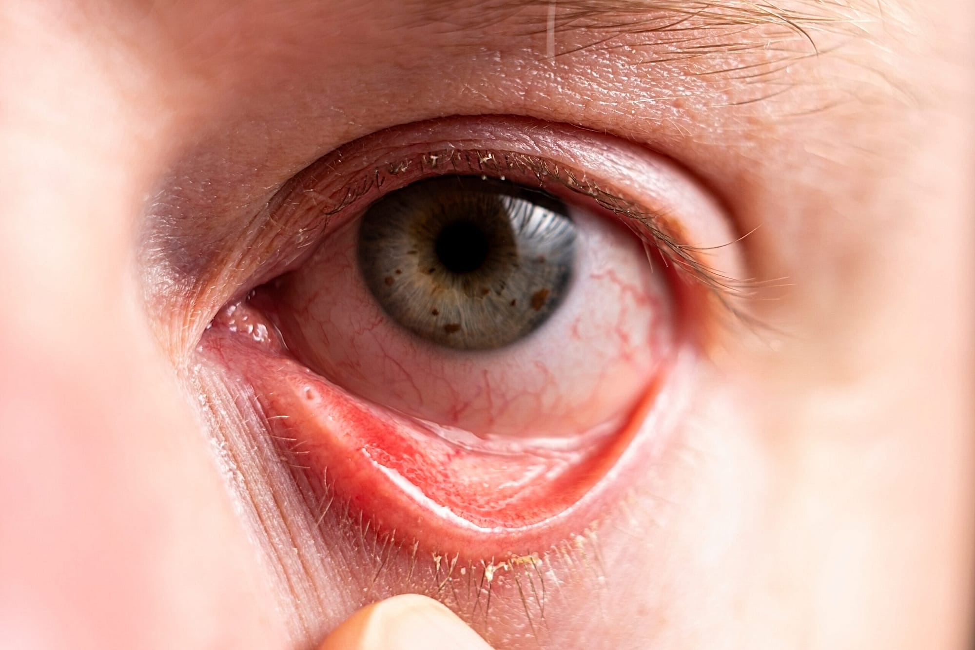Reddened eye with suppuration on eyelashes closeup