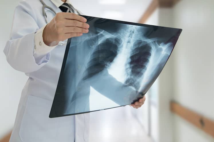 Doctor examining chest x-ray film