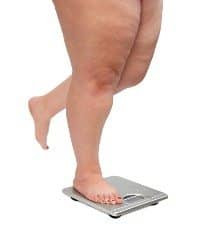 Obesity Causing Limb Amputation Epidemic in Scotland