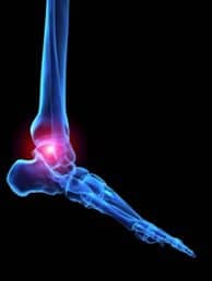 Arthritis and Foot Pain